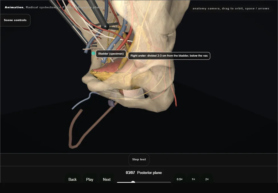 Radical cystectomy + PLND (extirpative phase). Step 3: Posterior plane. Captured frame from the interactive animation.