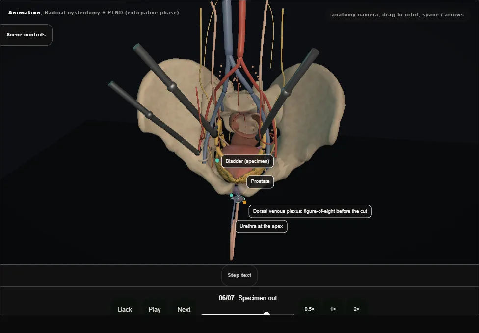 Radical cystectomy + PLND (extirpative phase). Step 6: Specimen out. Captured frame from the interactive animation.