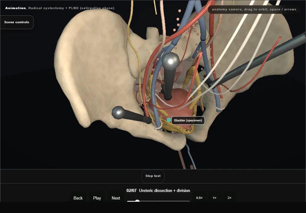 Radical cystectomy + PLND (extirpative phase). Step 2: Ureteric dissection + division. Captured frame from the interactive animation.