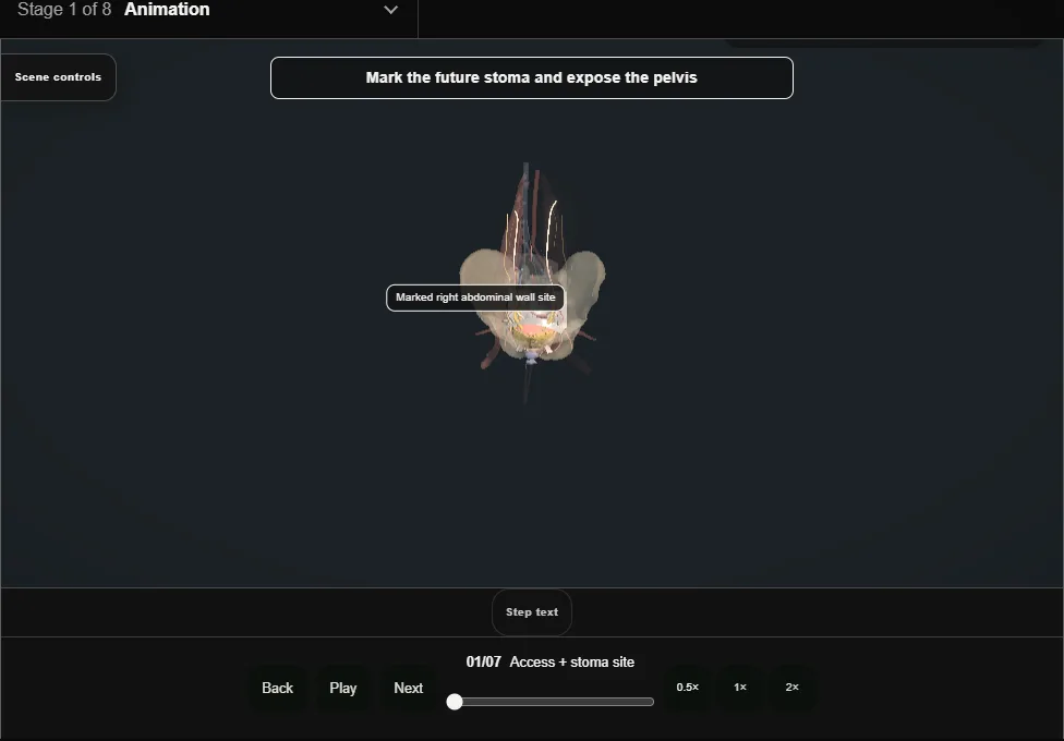 Radical cystectomy + ileal conduit. Step 1: Access + stoma site. Captured frame from the interactive animation.