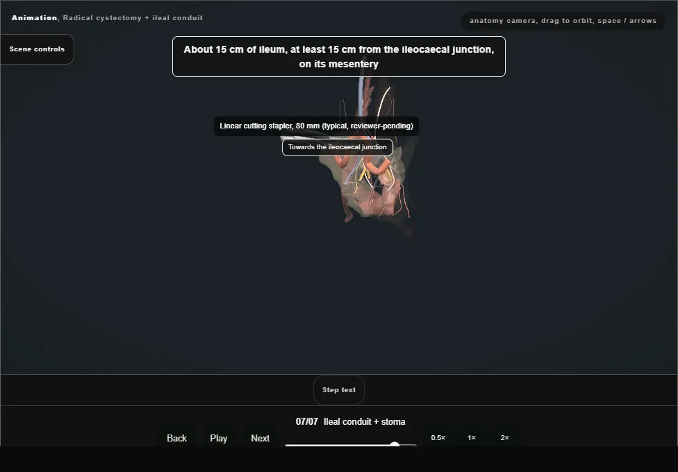 Radical cystectomy + ileal conduit. Step 7: Ileal conduit + stoma. Captured frame from the interactive animation.