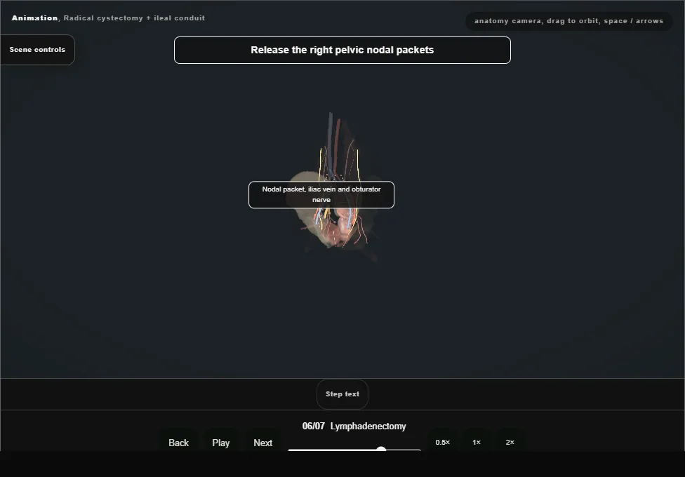 Radical cystectomy + ileal conduit. Step 6: Lymphadenectomy. Captured frame from the interactive animation.