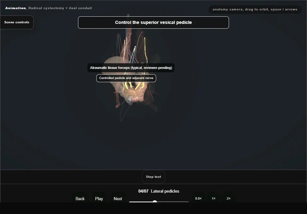 Radical cystectomy + ileal conduit. Step 4: Lateral pedicles. Captured frame from the interactive animation.