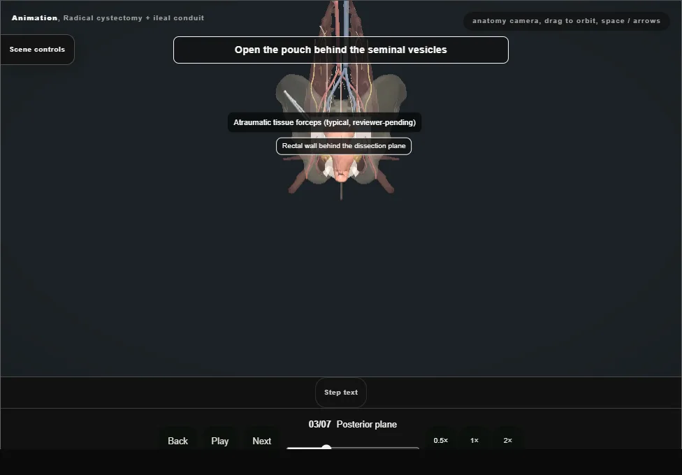 Radical cystectomy + ileal conduit. Step 3: Posterior plane. Captured frame from the interactive animation.