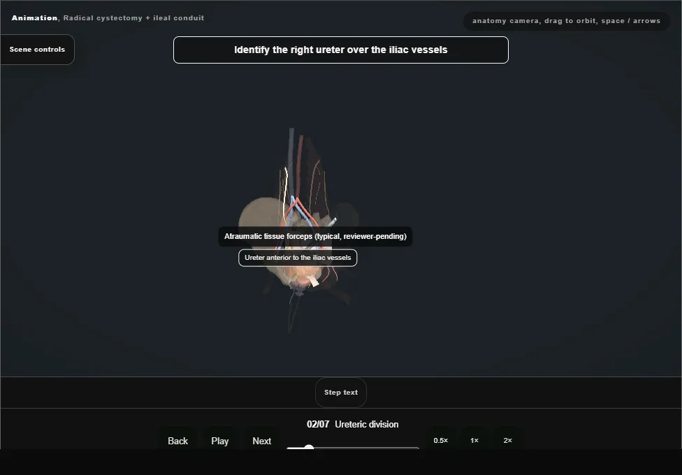 Radical cystectomy + ileal conduit. Step 2: Ureteric division. Captured frame from the interactive animation.