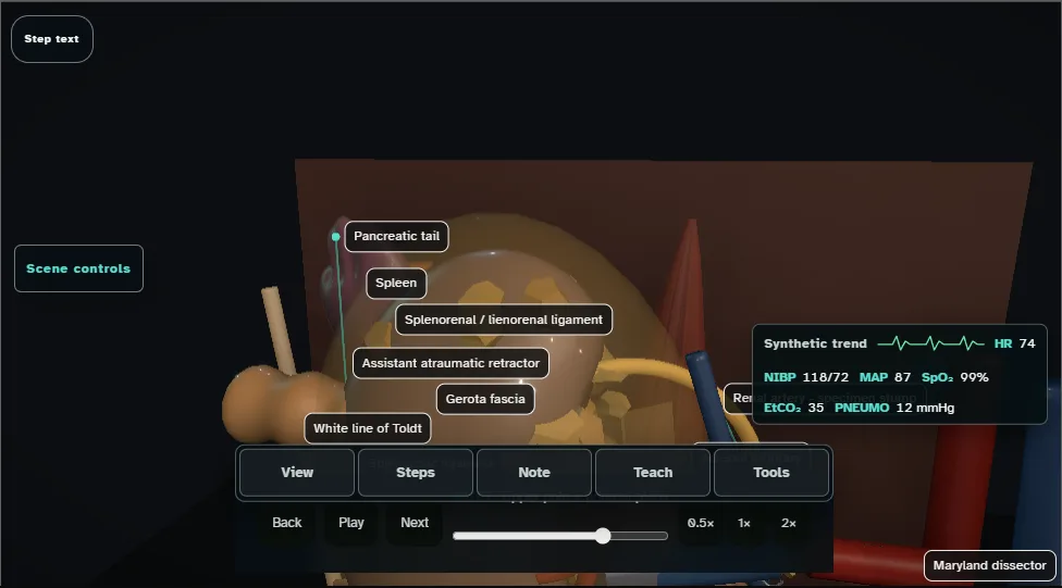 Radical nephrectomy (laparoscopic) - spatial danger atlas. Step 6: Upper pole + adrenal plane. Captured frame from the interactive animation.