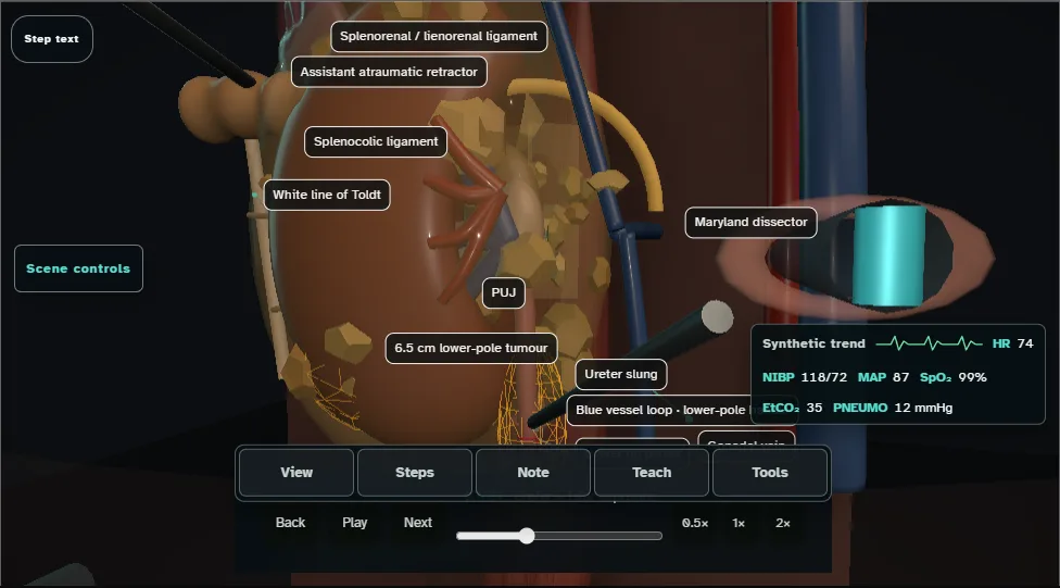 Radical nephrectomy (laparoscopic) - spatial danger atlas. Step 3: Ureter + hilar exposure. Captured frame from the interactive animation.