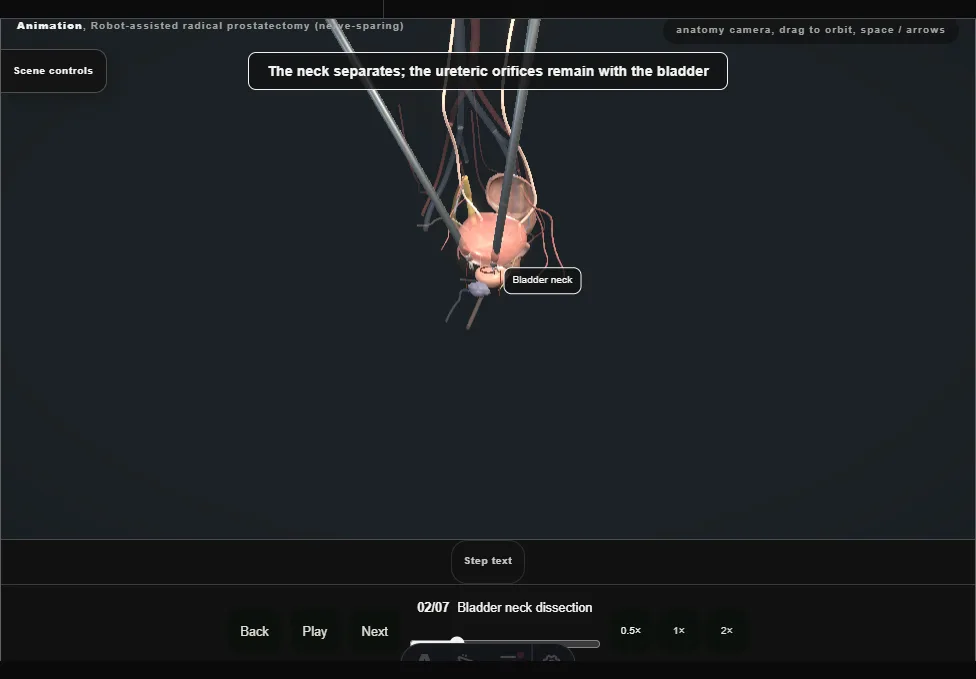 Robot-assisted radical prostatectomy (nerve-sparing). Step 2: Bladder neck dissection. Captured frame from the interactive animation.
