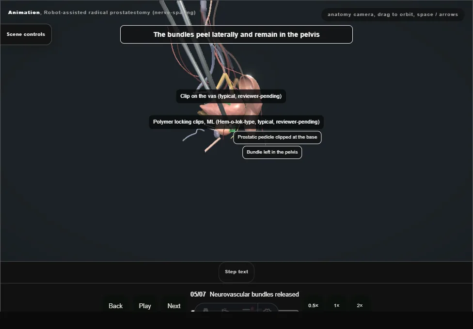 Robot-assisted radical prostatectomy (nerve-sparing). Step 5: Neurovascular bundles released. Captured frame from the interactive animation.