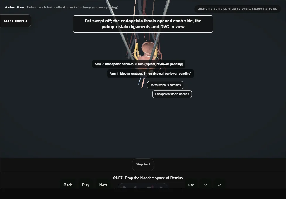 Robot-assisted radical prostatectomy (nerve-sparing). Step 1: Drop the bladder: space of Retzius. Captured frame from the interactive animation.