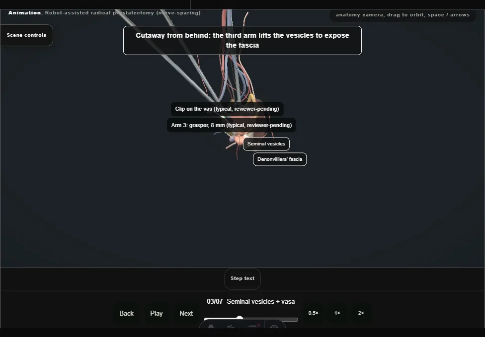 Robot-assisted radical prostatectomy (nerve-sparing). Step 3: Seminal vesicles + vasa. Captured frame from the interactive animation.