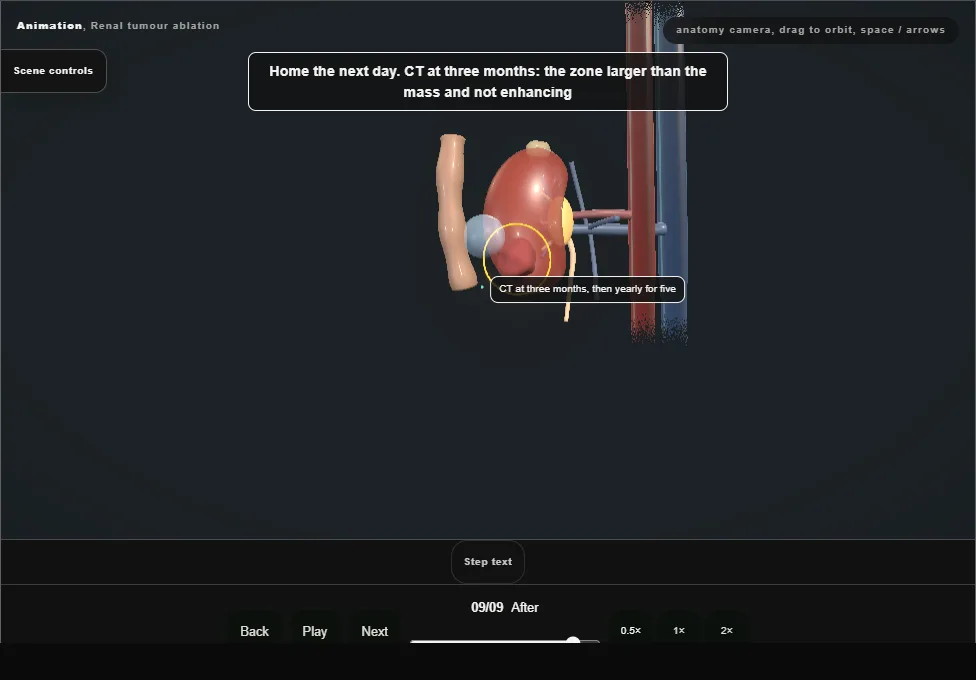 Renal tumour ablation. Step 9: After. Captured frame from the interactive animation.
