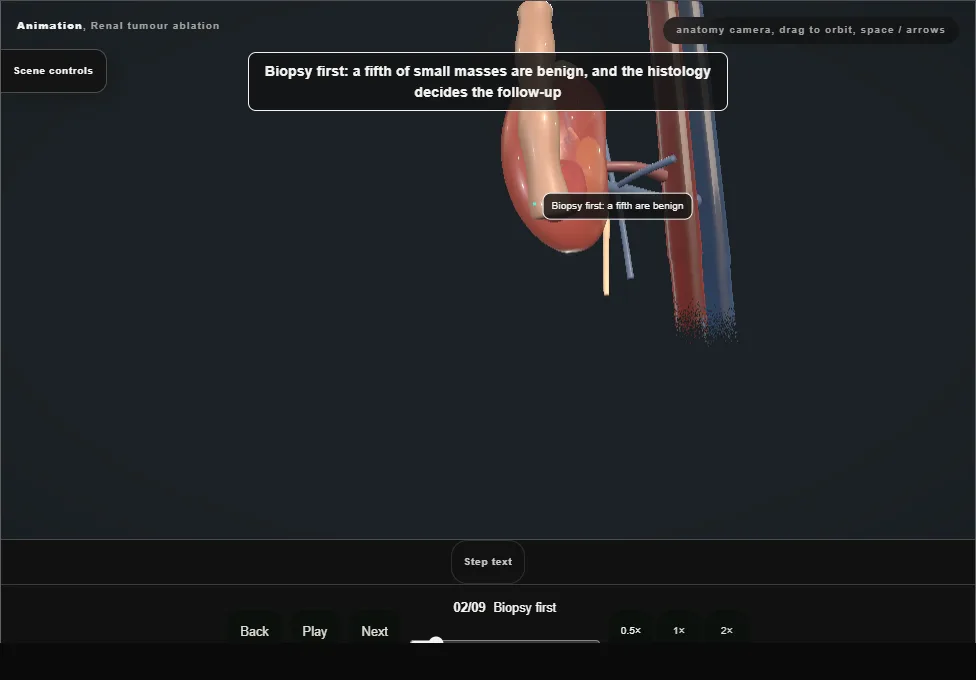 Renal tumour ablation. Step 2: Biopsy first. Captured frame from the interactive animation.