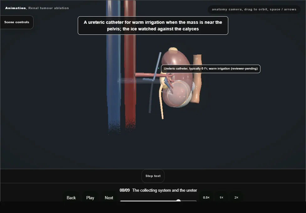 Renal tumour ablation. Step 8: The collecting system and the ureter. Captured frame from the interactive animation.