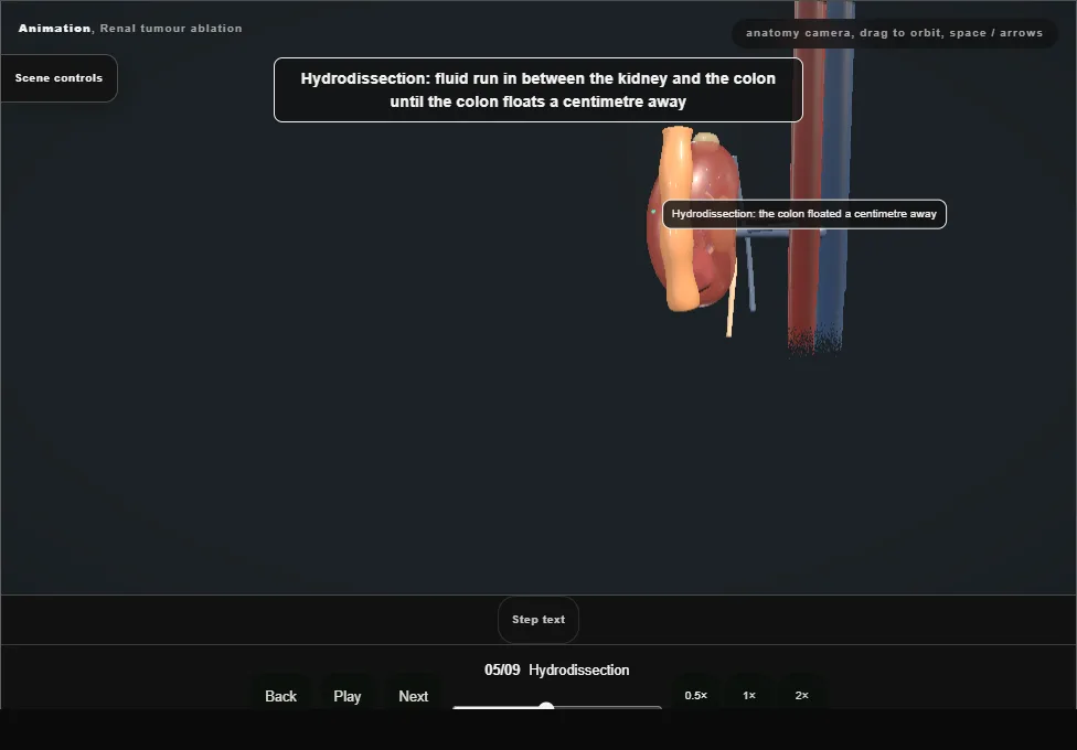 Renal tumour ablation. Step 5: Hydrodissection. Captured frame from the interactive animation.