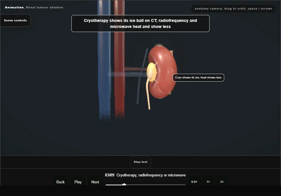 Renal tumour ablation. Step 3: Cryotherapy, radiofrequency or microwave. Captured frame from the interactive animation.