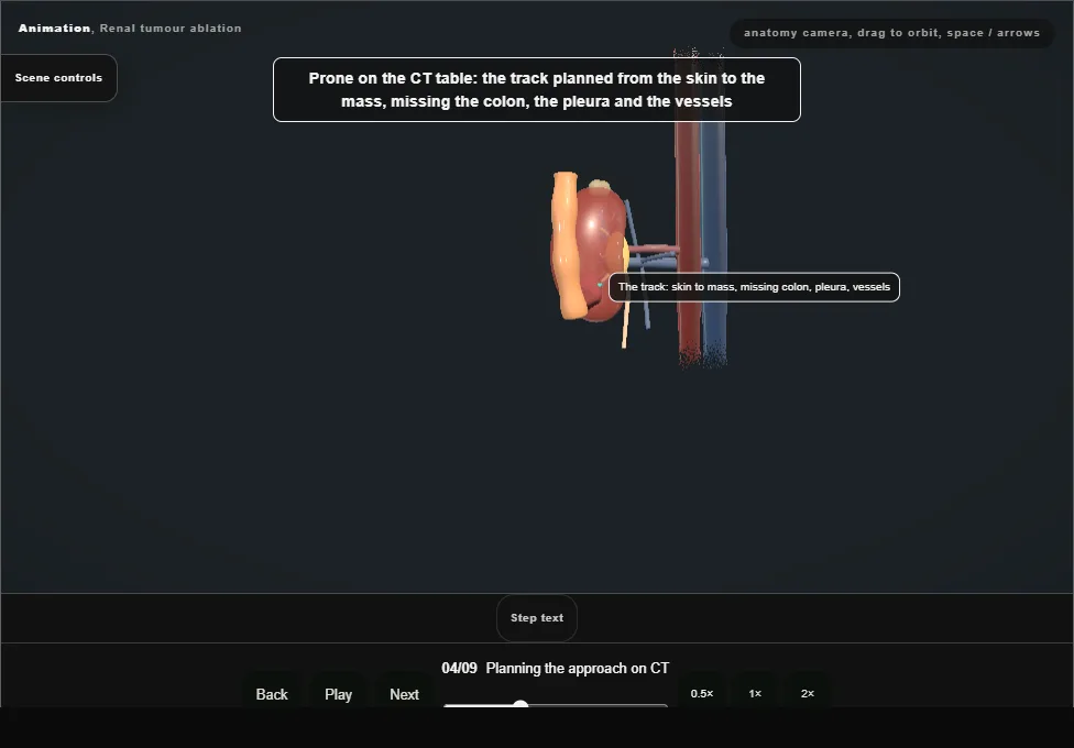 Renal tumour ablation. Step 4: Planning the approach on CT. Captured frame from the interactive animation.