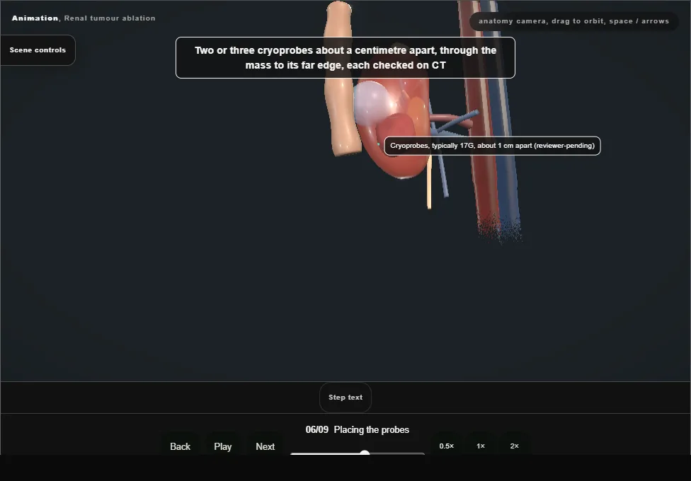 Renal tumour ablation. Step 6: Placing the probes. Captured frame from the interactive animation.