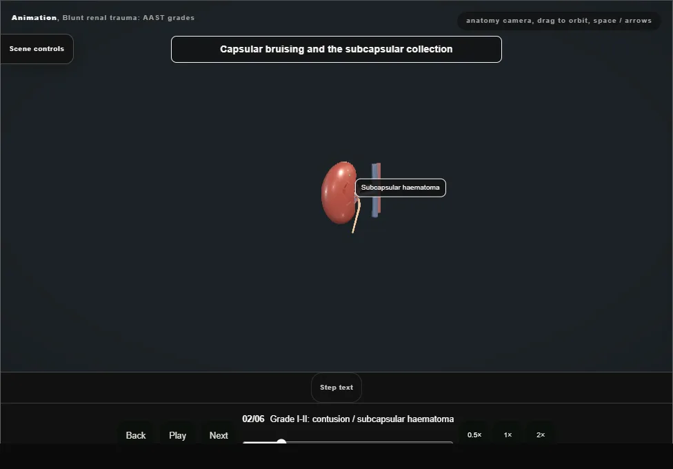 Blunt renal trauma: AAST grades. Step 2: Grade I-II: contusion / subcapsular haematoma. Captured frame from the interactive animation.