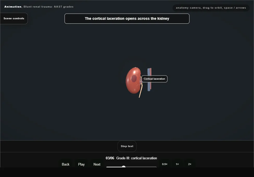 Blunt renal trauma: AAST grades. Step 3: Grade III: cortical laceration. Captured frame from the interactive animation.
