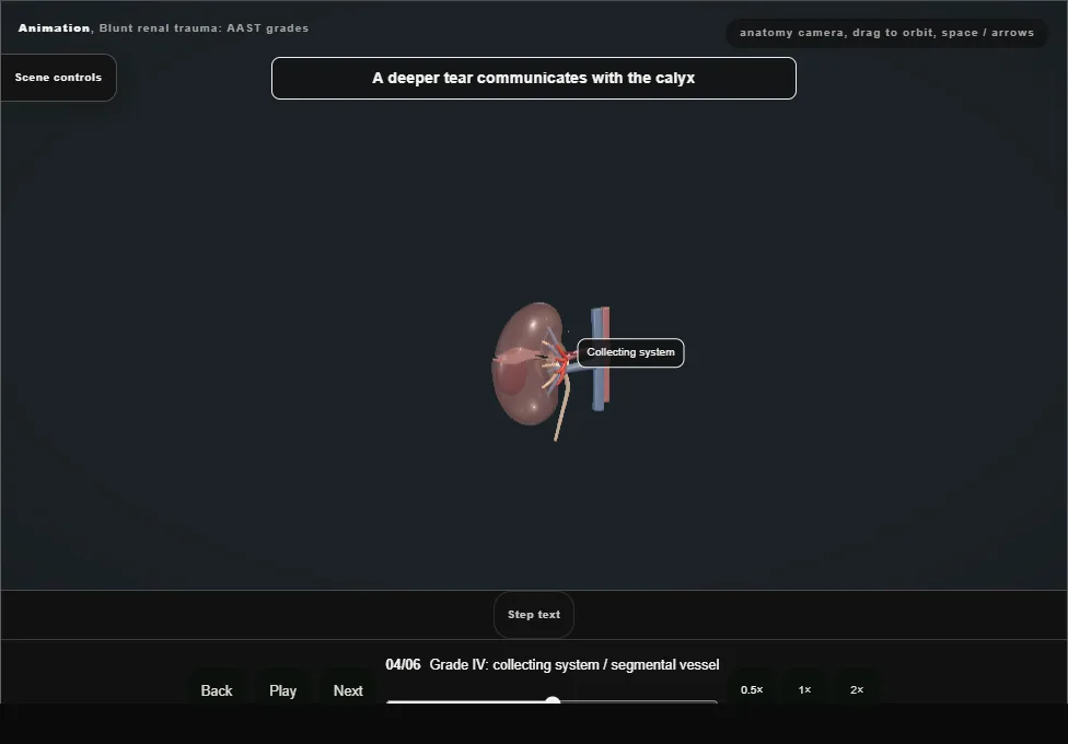 Blunt renal trauma: AAST grades. Step 4: Grade IV: collecting system / segmental vessel. Captured frame from the interactive animation.