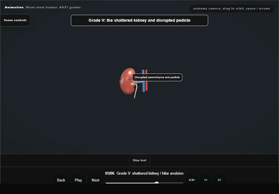 Blunt renal trauma: AAST grades. Step 5: Grade V: shattered kidney / hilar avulsion. Captured frame from the interactive animation.
