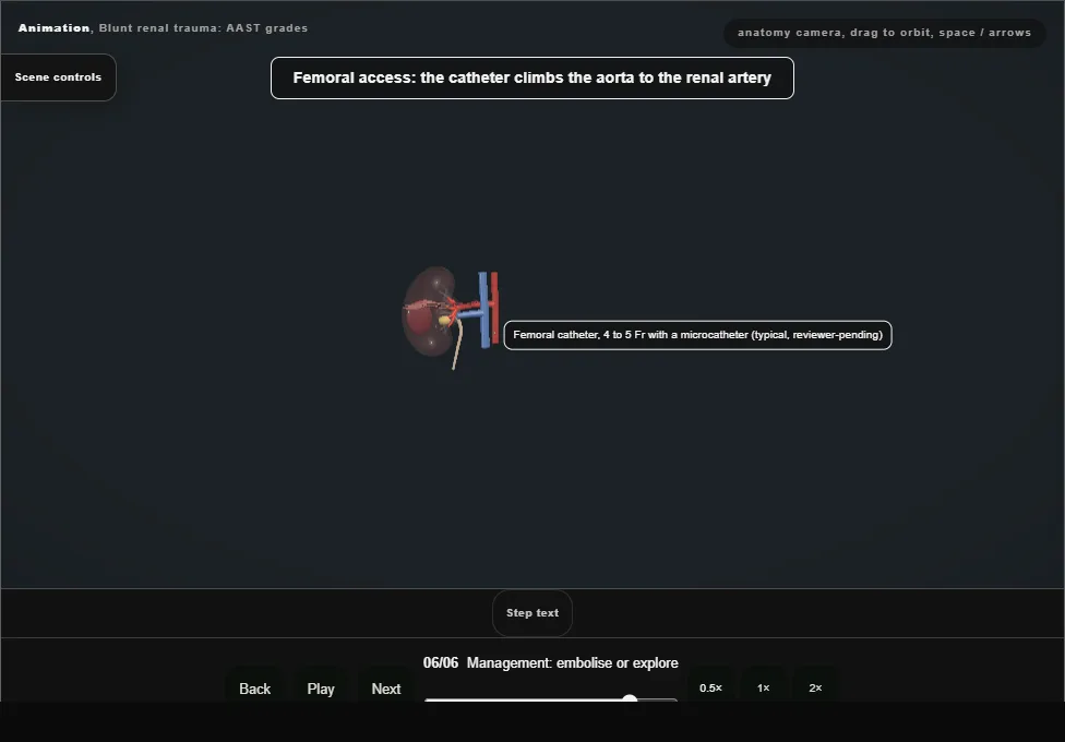 Blunt renal trauma: AAST grades. Step 6: Management: embolise or explore. Captured frame from the interactive animation.