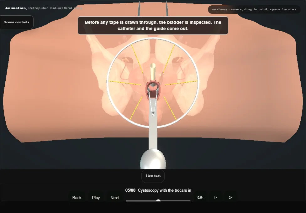 Retropubic mid-urethral sling. Step 5: Cystoscopy with the trocars in. Captured frame from the interactive animation.