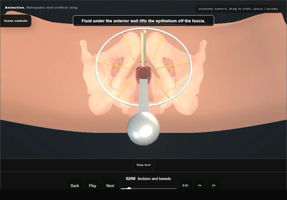 Retropubic mid-urethral sling. Step 2: Incision and tunnels. Captured frame from the interactive animation.