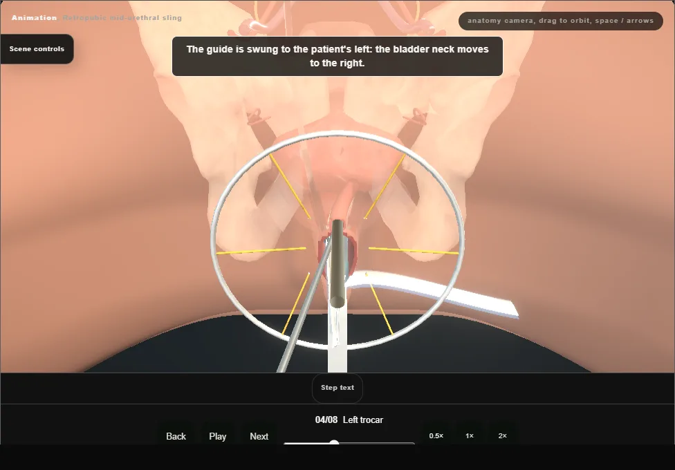 Retropubic mid-urethral sling. Step 4: Left trocar. Captured frame from the interactive animation.