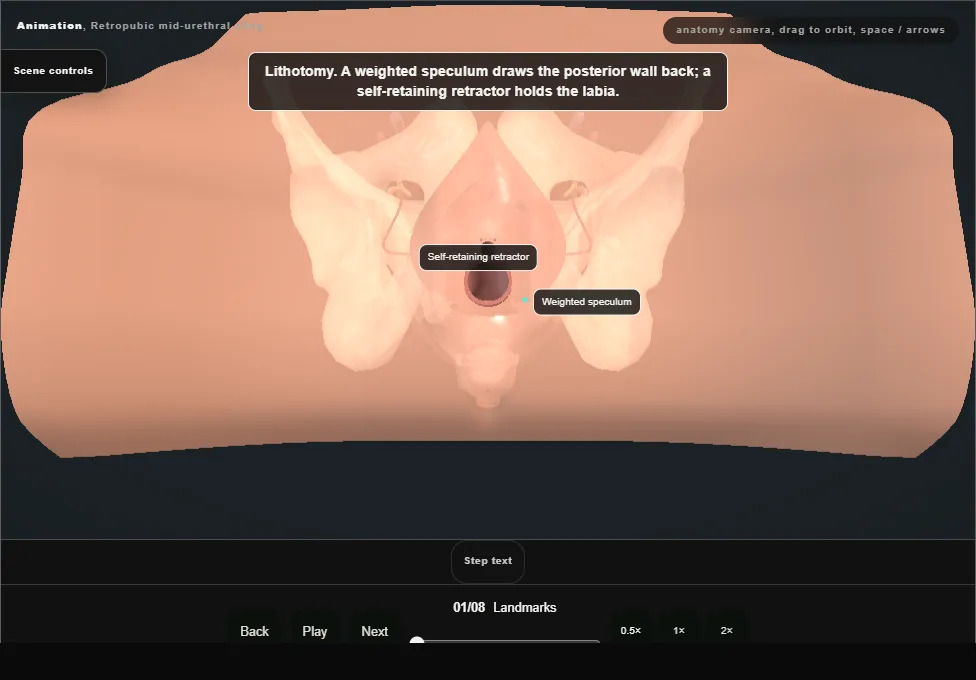 Retropubic mid-urethral sling. Step 1: Landmarks. Captured frame from the interactive animation.