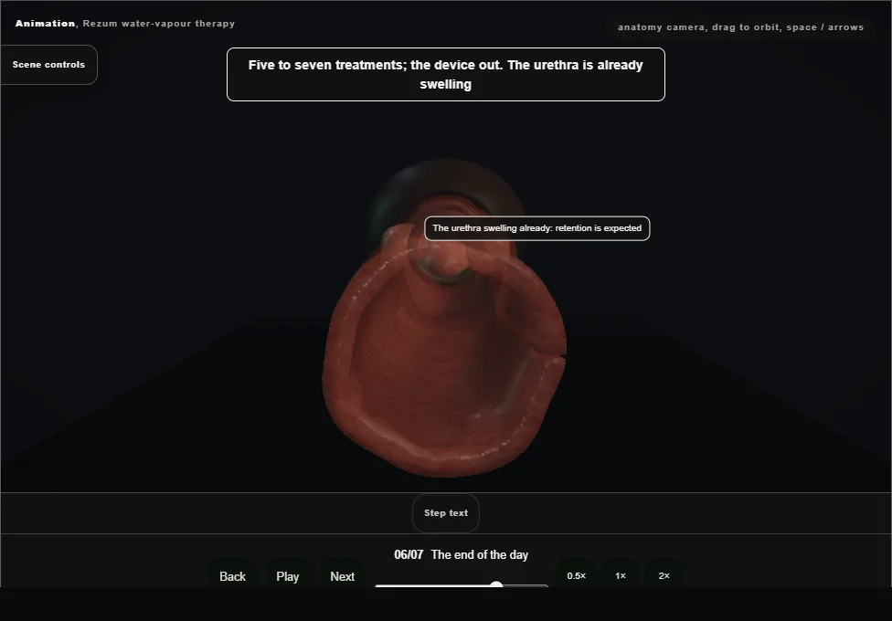 Rezum water-vapour therapy. Step 6: The end of the day. Captured frame from the interactive animation.