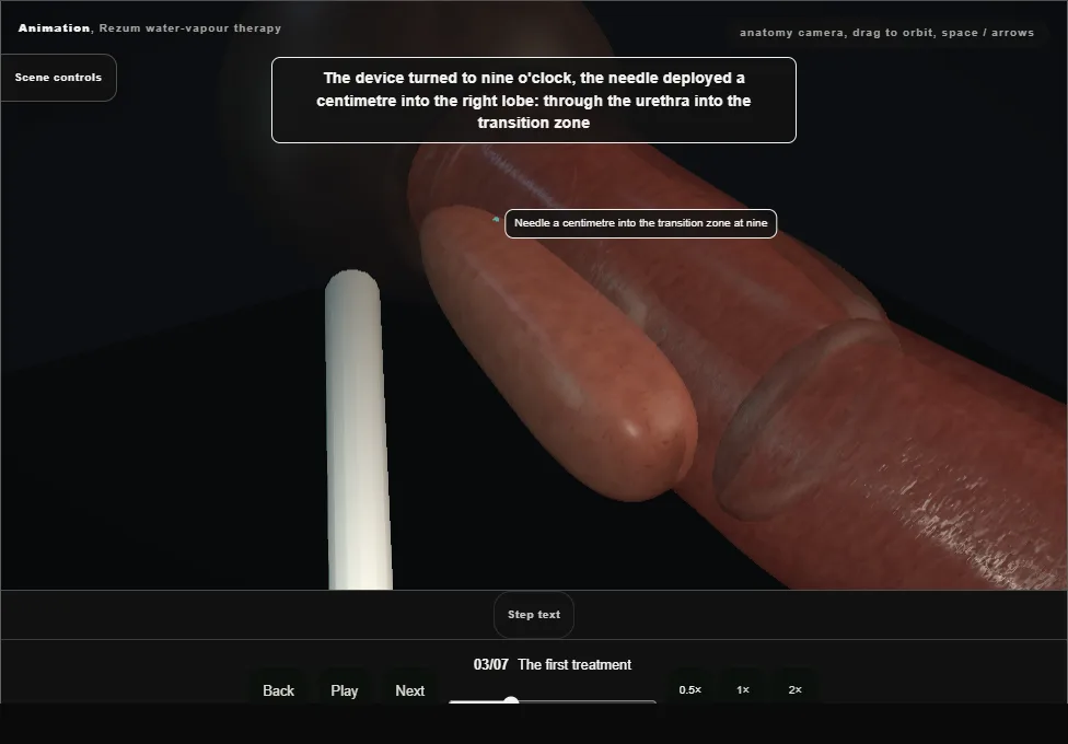 Rezum water-vapour therapy. Step 3: The first treatment. Captured frame from the interactive animation.