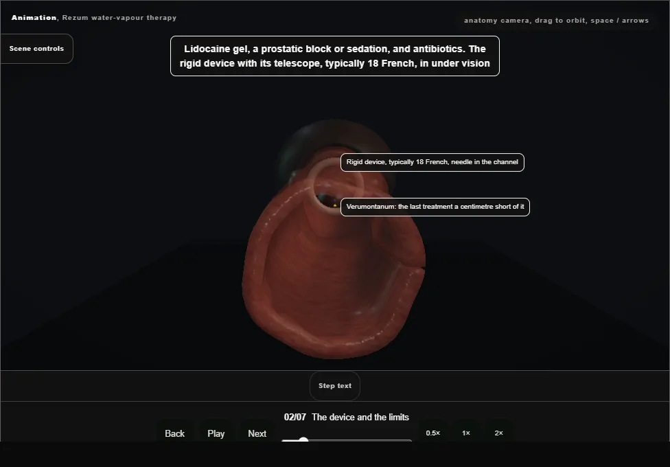 Rezum water-vapour therapy. Step 2: The device and the limits. Captured frame from the interactive animation.