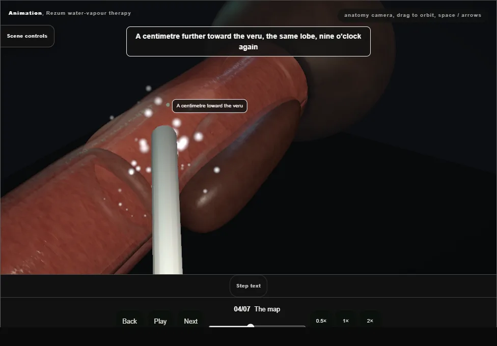 Rezum water-vapour therapy. Step 4: The map. Captured frame from the interactive animation.