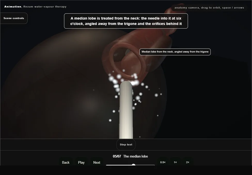 Rezum water-vapour therapy. Step 5: The median lobe. Captured frame from the interactive animation.
