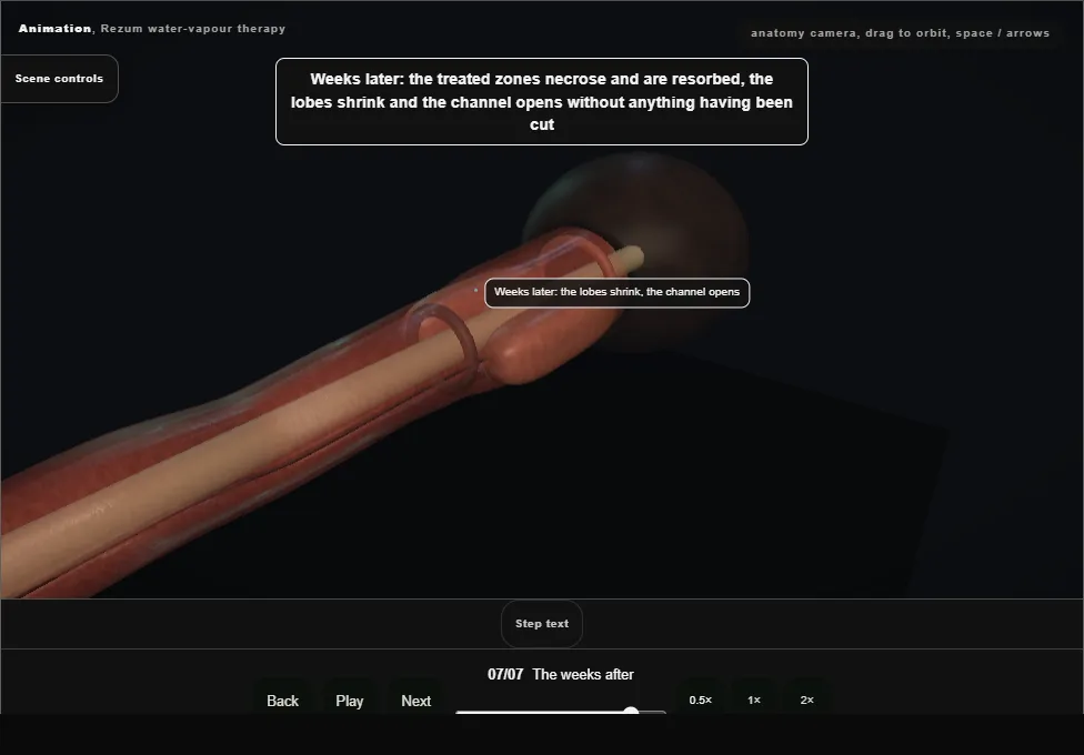 Rezum water-vapour therapy. Step 7: The weeks after. Captured frame from the interactive animation.