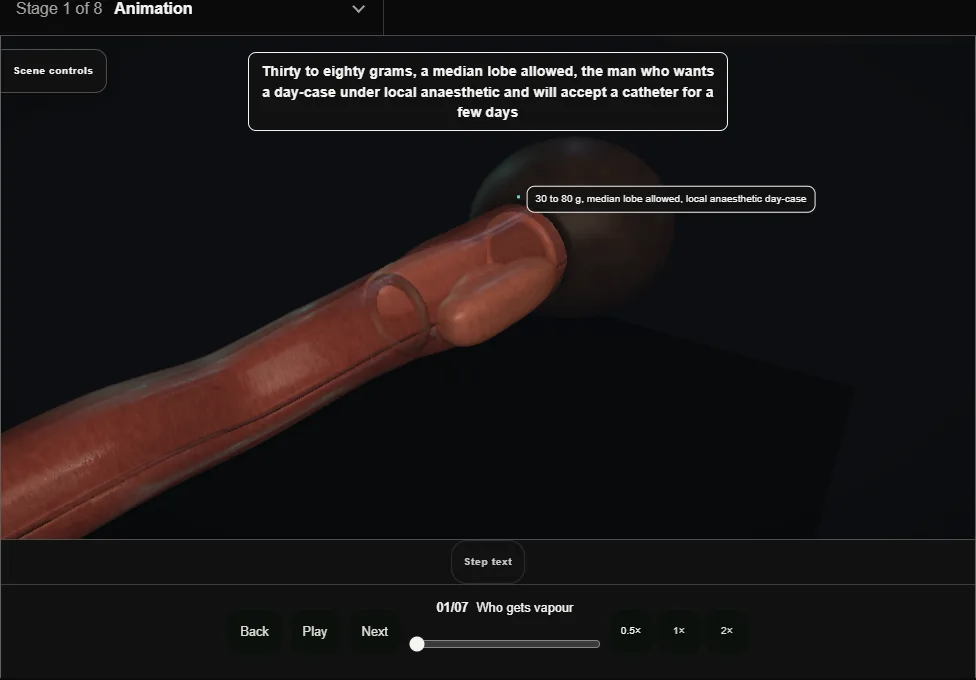 Rezum water-vapour therapy. Step 1: Who gets vapour. Captured frame from the interactive animation.