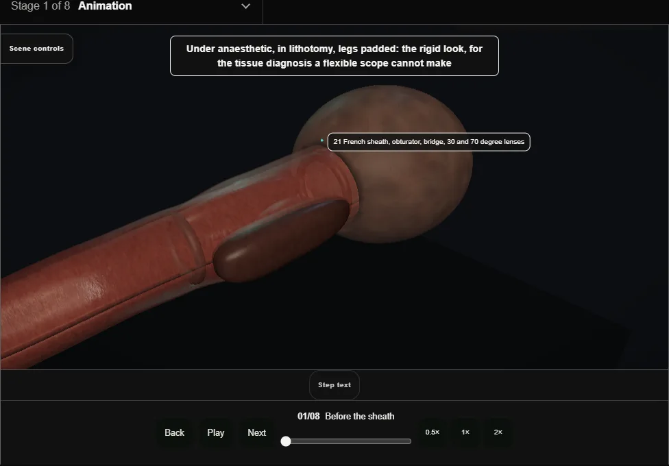 Rigid cystoscopy, biopsy and fulguration. Step 1: Before the sheath. Captured frame from the interactive animation.