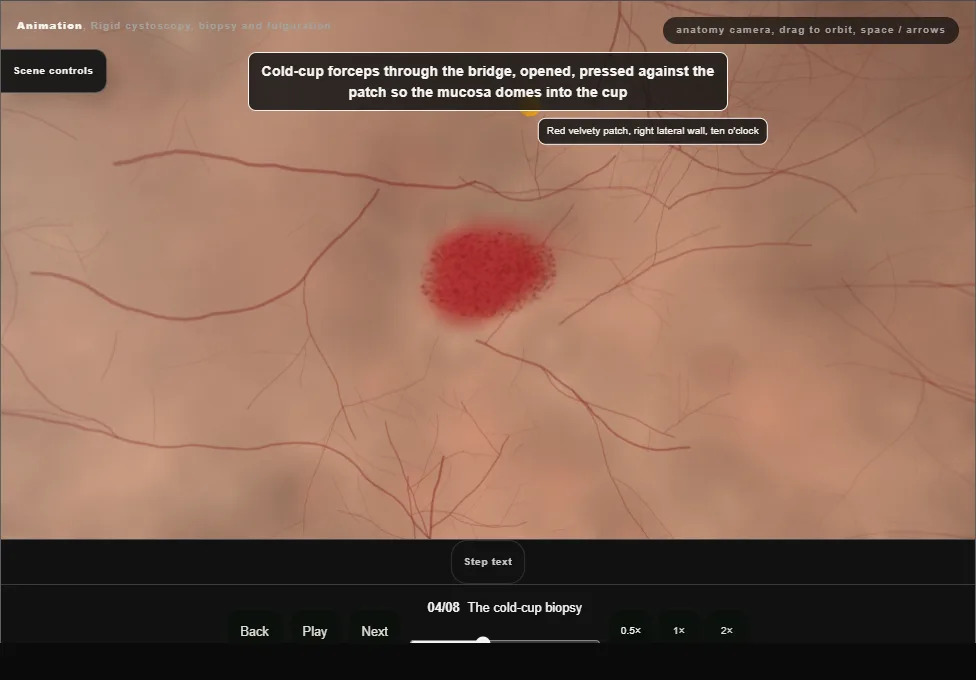 Rigid cystoscopy, biopsy and fulguration. Step 4: The cold-cup biopsy. Captured frame from the interactive animation.