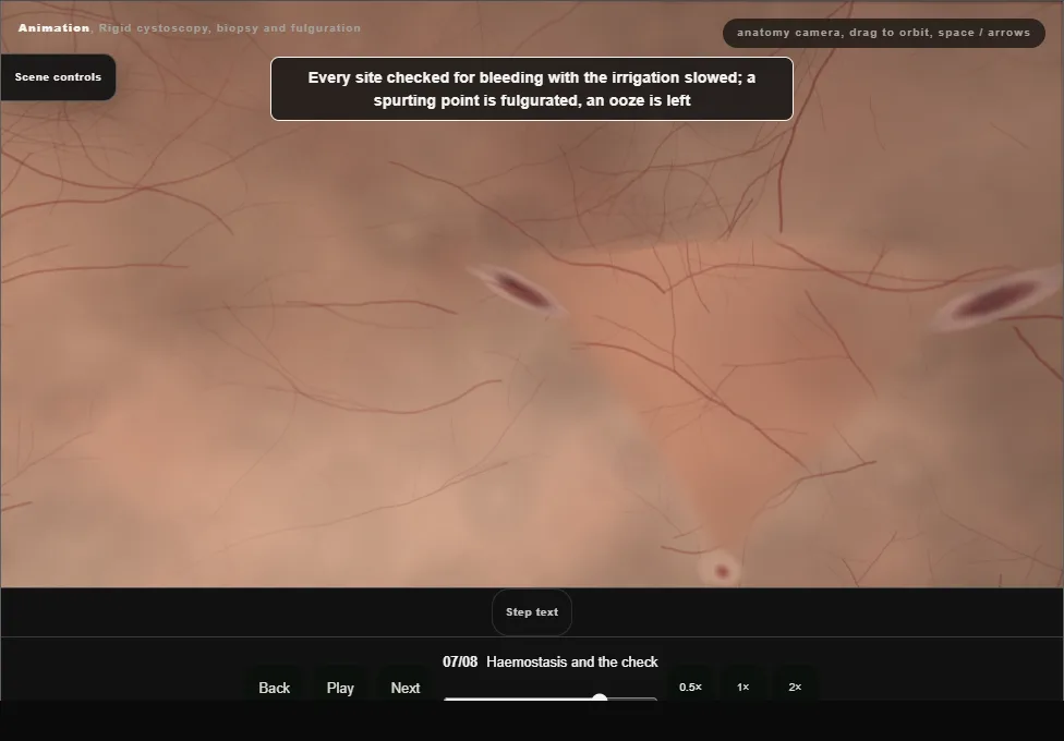 Rigid cystoscopy, biopsy and fulguration. Step 7: Haemostasis and the check. Captured frame from the interactive animation.