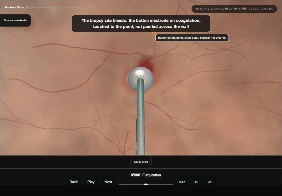 Rigid cystoscopy, biopsy and fulguration. Step 5: Fulguration. Captured frame from the interactive animation.
