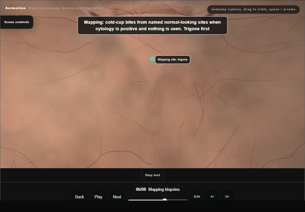 Rigid cystoscopy, biopsy and fulguration. Step 6: Mapping biopsies. Captured frame from the interactive animation.