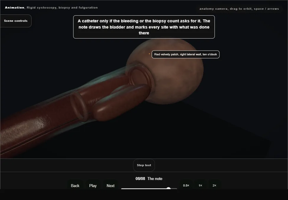 Rigid cystoscopy, biopsy and fulguration. Step 8: The note. Captured frame from the interactive animation.