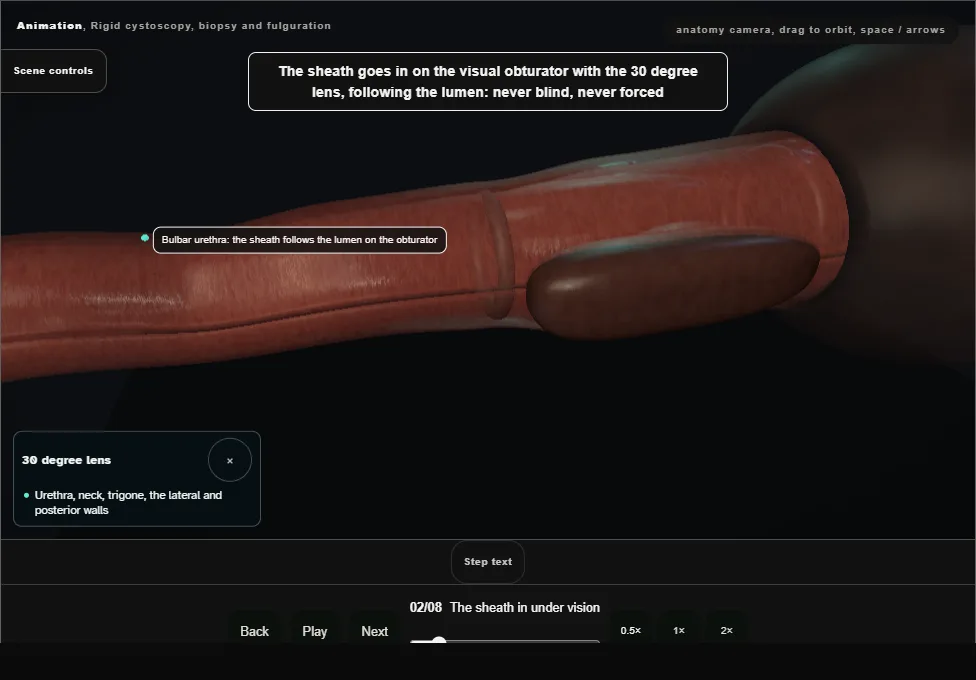 Rigid cystoscopy, biopsy and fulguration. Step 2: The sheath in under vision. Captured frame from the interactive animation.
