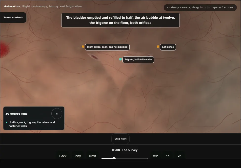 Rigid cystoscopy, biopsy and fulguration. Step 3: The survey. Captured frame from the interactive animation.