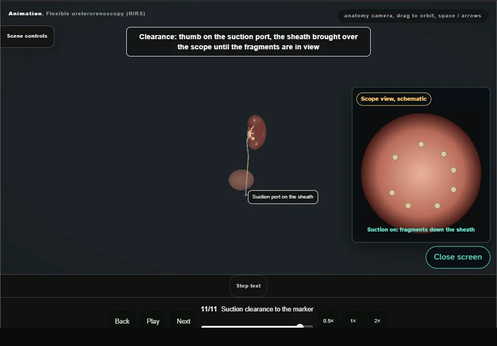 Flexible ureterorenoscopy (RIRS). Step 11: Suction clearance to the marker. Captured frame from the interactive animation.