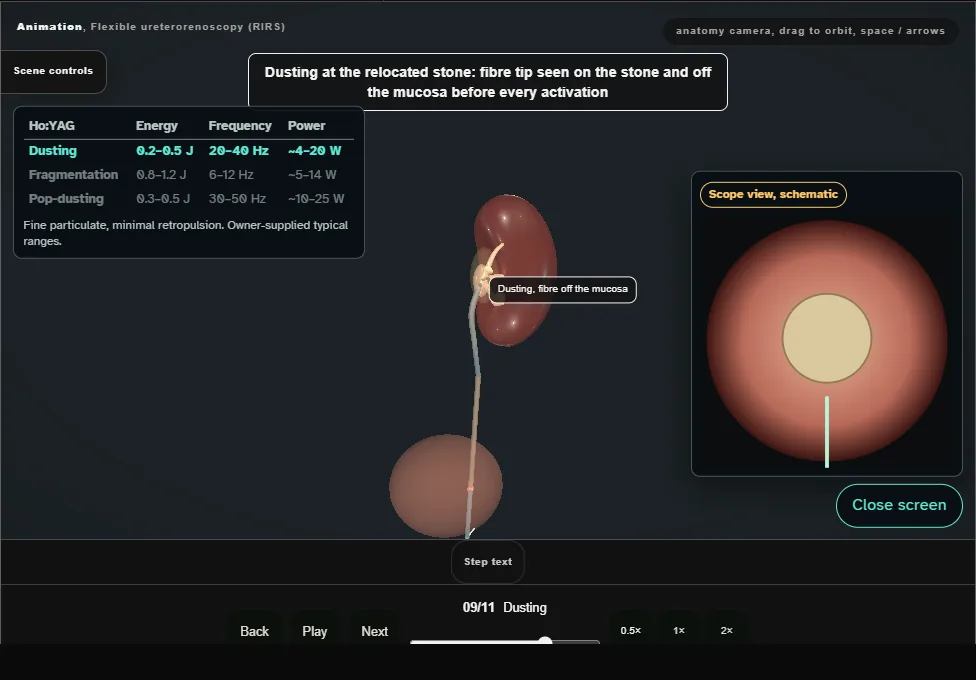 Flexible ureterorenoscopy (RIRS). Step 9: Dusting. Captured frame from the interactive animation.
