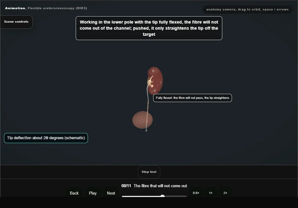 Flexible ureterorenoscopy (RIRS). Step 8: The fibre that will not come out. Captured frame from the interactive animation.