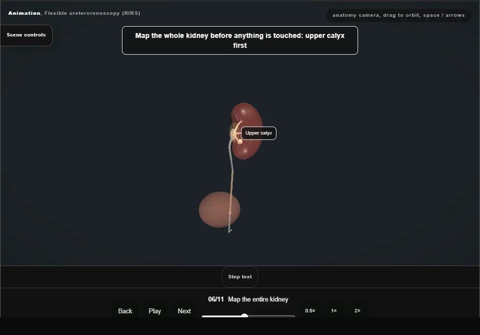 Flexible ureterorenoscopy (RIRS). Step 6: Map the entire kidney. Captured frame from the interactive animation.